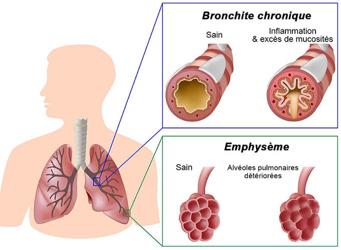 illustration de la bronchopneumopathie chronique obstructive et de la cigarette électronique