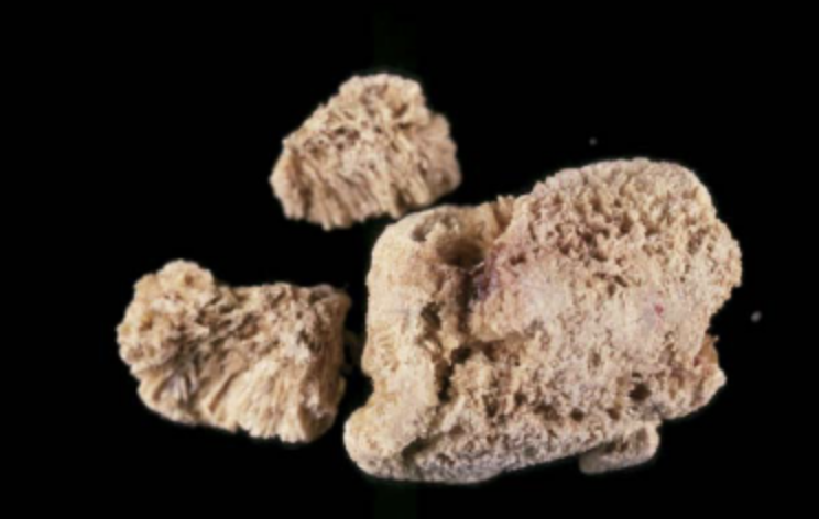 Photo sur fond noir d'une pierre à la couleur beige claire très caractéristique constituée par les reins suite à un traitement par Indinavir, un inhibiteur de protéase. 