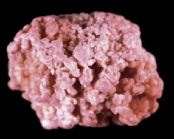 Photo sur fond noir d'une pierre à la couleur rose très caractéristique constituée par les reins suite à un traitement par sulfadiazine, un antibiotique. 