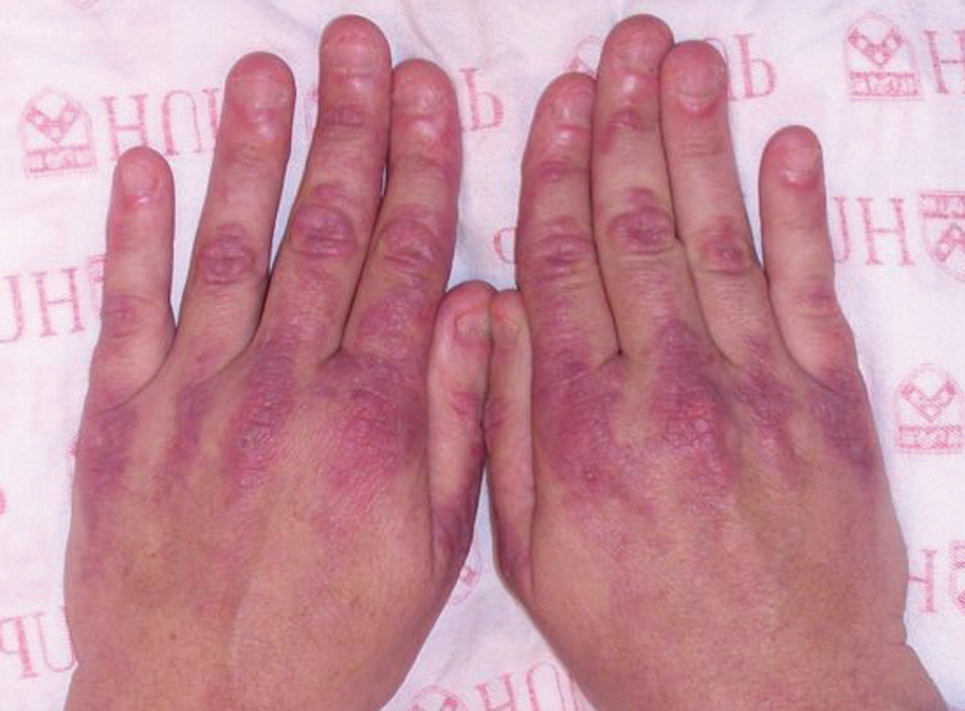 dermatomyosite provoquant des tâches rouges sur les mains suite à la prise de spiruline