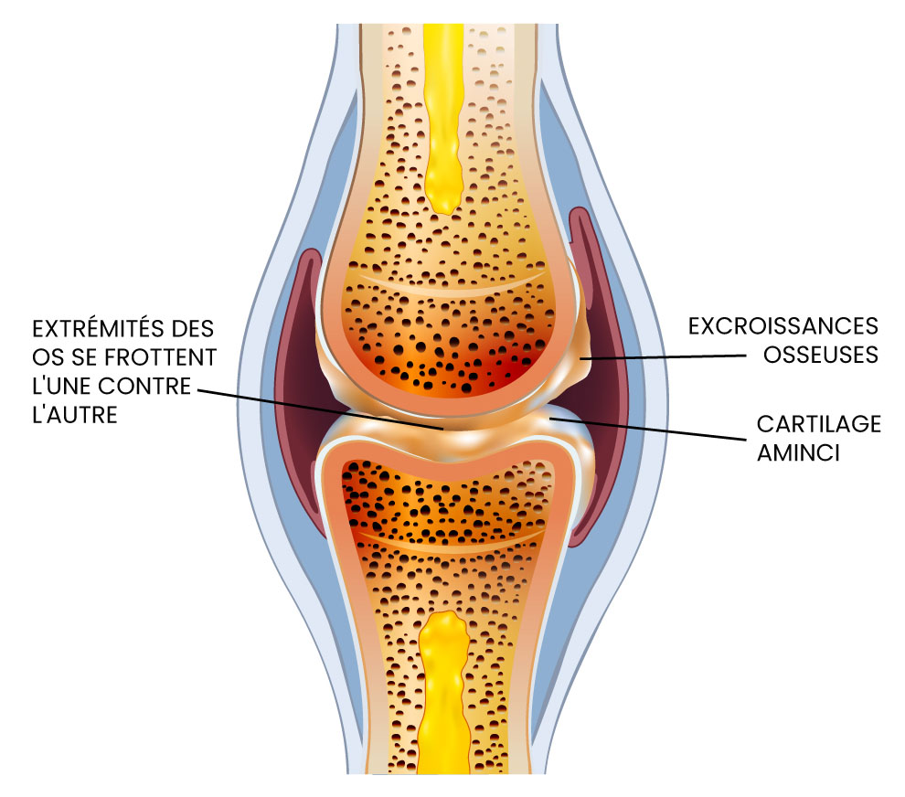 dessin d'une articulation atteinte d'arthrose montrant le cartilage aminci