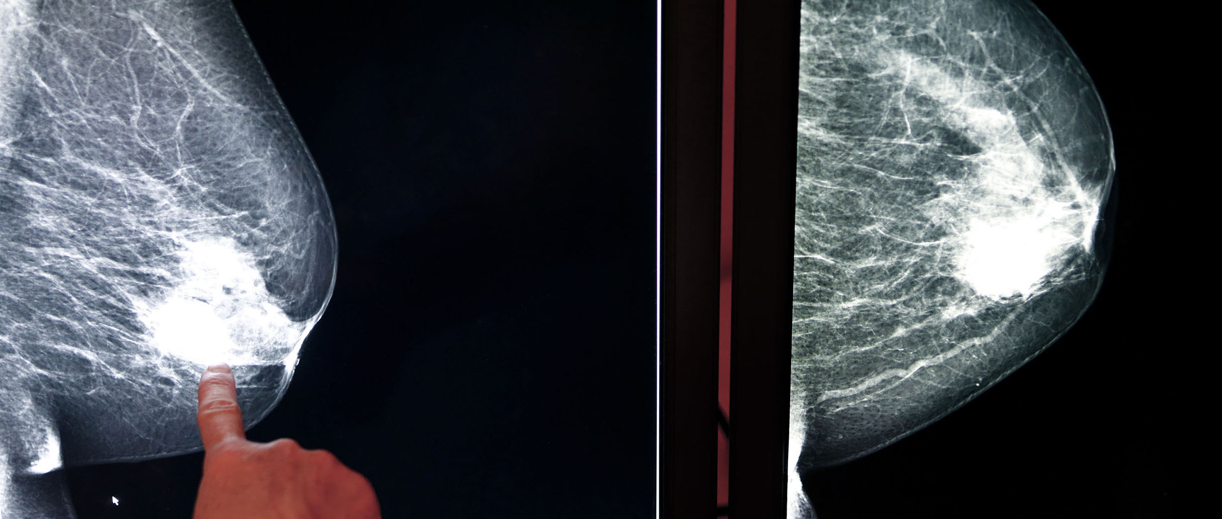 image aux rayons X d'un cancer du sein