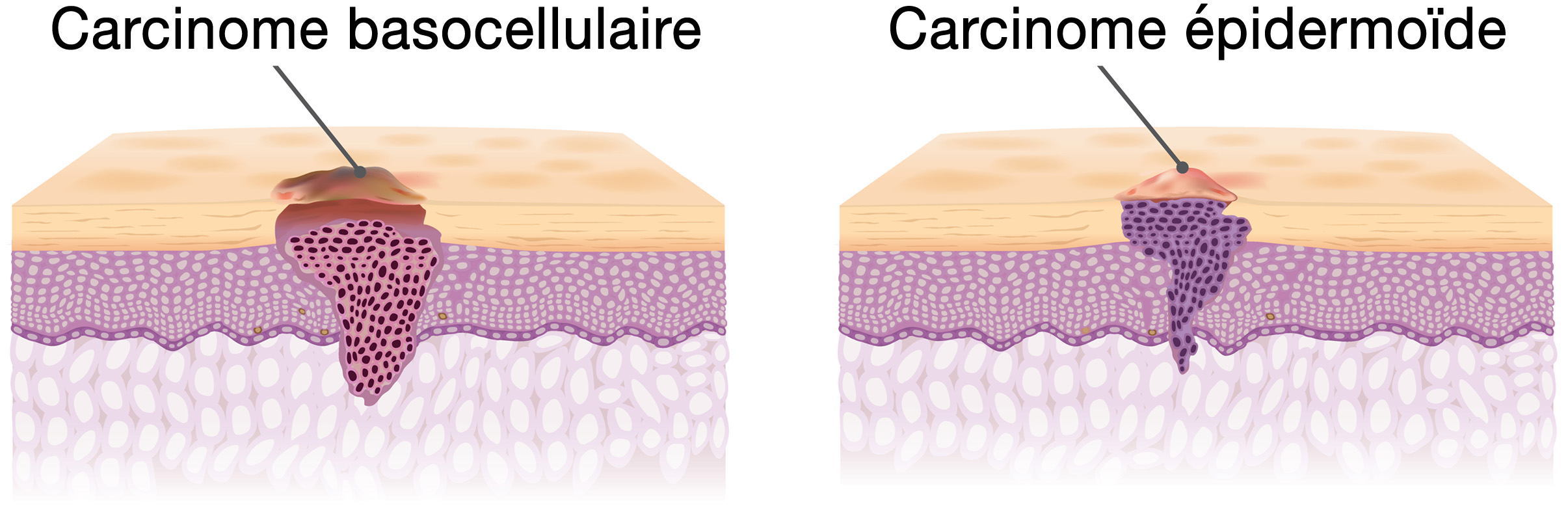 carcinome basocellulaire et carcinome épidermoïde