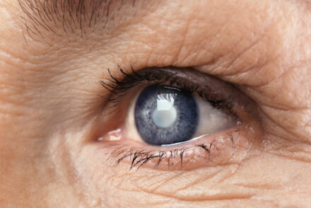 oeil atteint de cataracte