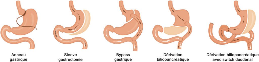 Les différentes formes de chirurgie bariatrique modifient la conformation du système digestif