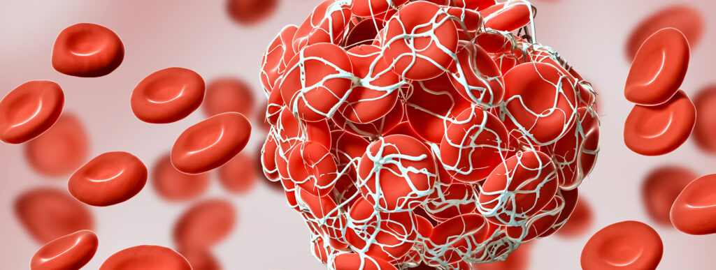 Représentation 3D d'un caillot de sang