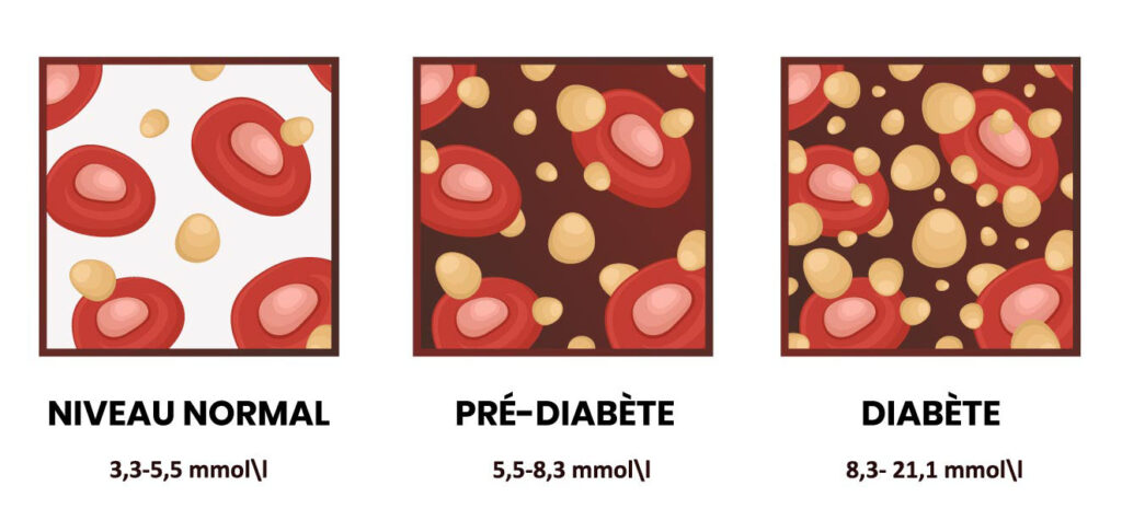 dessin montrant le sucre dans le sang en cas de diabète et pré-diabète