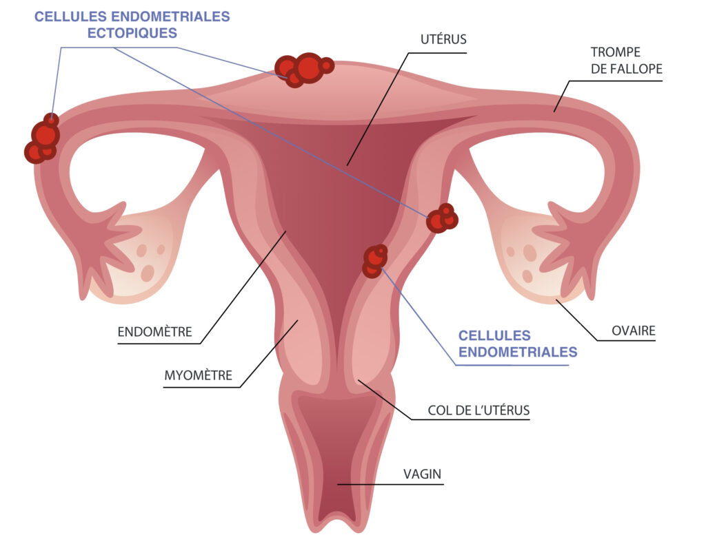Schéma représentant l'utérus avec ces différentes parties, le vagin en bas et en remontant; le col de l'utérus, le myomètre, l'endomètre, l'utérus, les trompes de Fallope et les ovaires.

Ce schéma décrit les cellule ectopique qui sont des cellules de l’endomètre qui migrent et se mettent à proliférer dans différents endroits où elles ne devraient pas se trouver. Elles entrainent alors plusieurs mécanismes de défenses notamment une réaction anti-inflammatoire qui font ressentir de la douleurs.

Dans le schéma, on montre une colonisation des cellules endométriales ectopiques dans les trompes de Fallope et à l'extérieur de l'utérus.