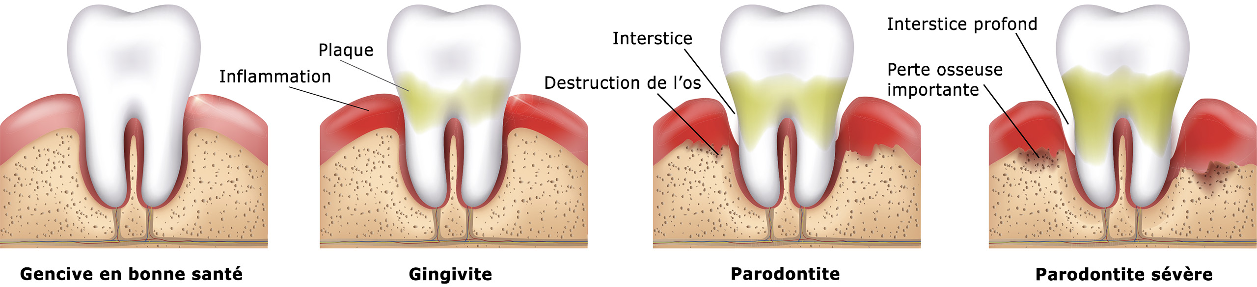 Évolution de la parodontite