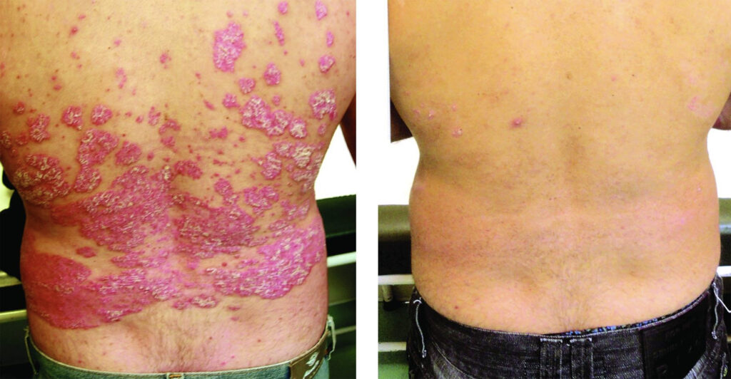 Evolution d'un patient atteint de psoriasis après 6 mois de traitement à 35000UI de vitamine D par jour