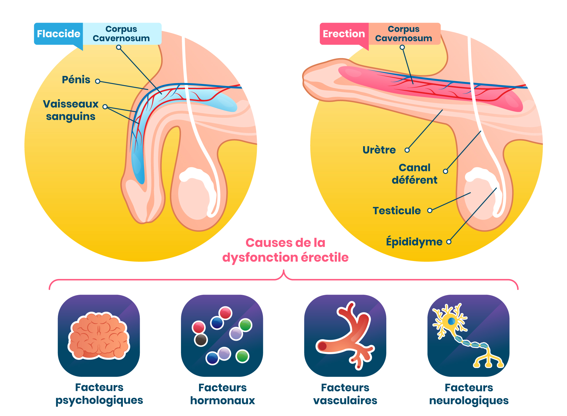 schéma illustrant les causes de la dysfonction érectile