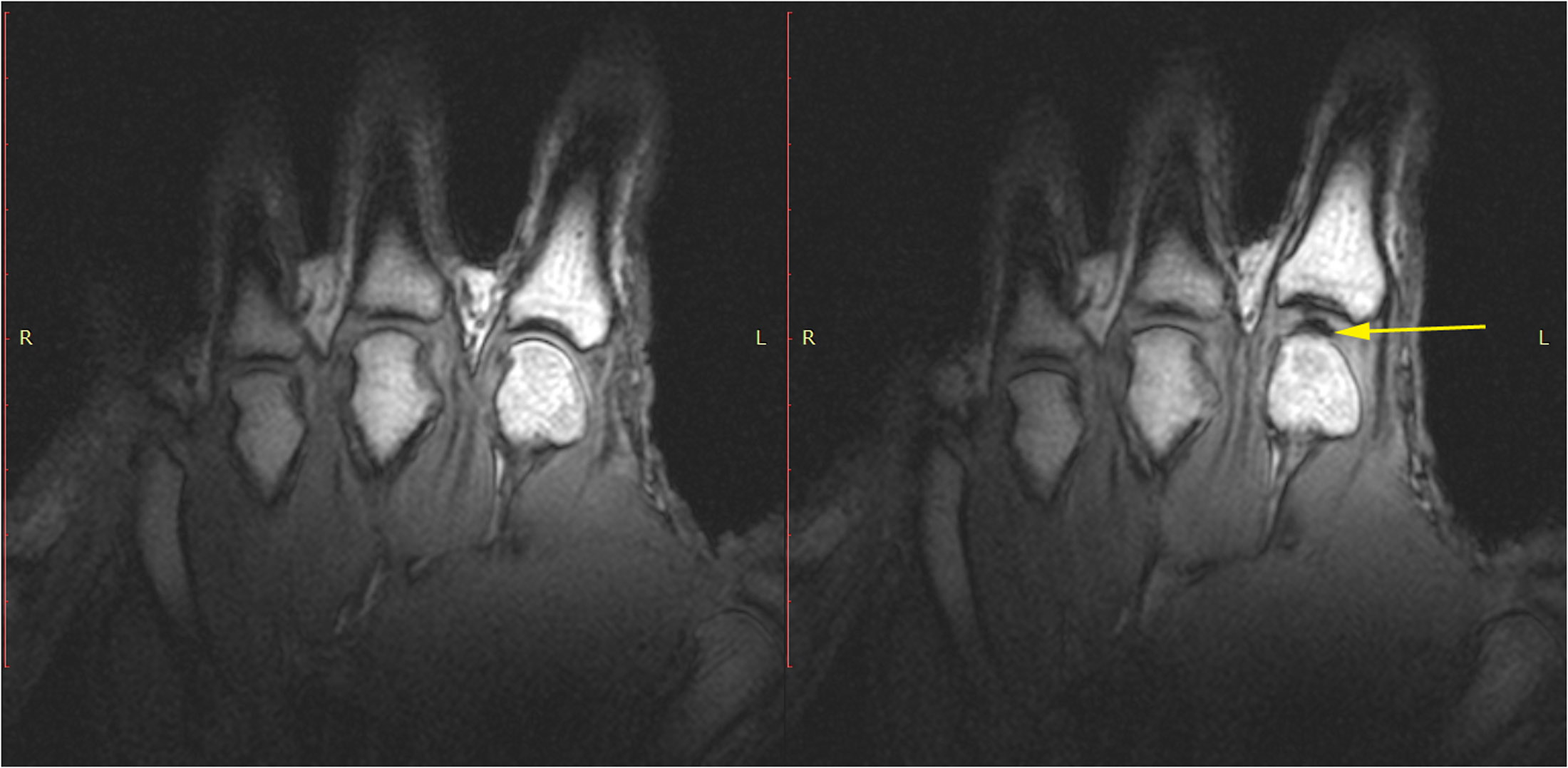 IRM montrant la cavité gazeuse dans un doigt lorsqu'on le fait craquer