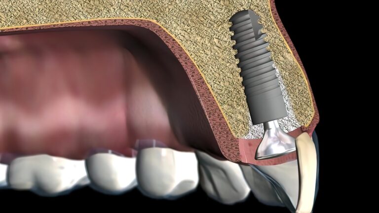Schéma en 3D d'une bouche montrant l'intérieur de la gencive et de la structure osseuse. Un implant est visé dans la gencive et l'os permettant d'installer une nouvelle dent. 