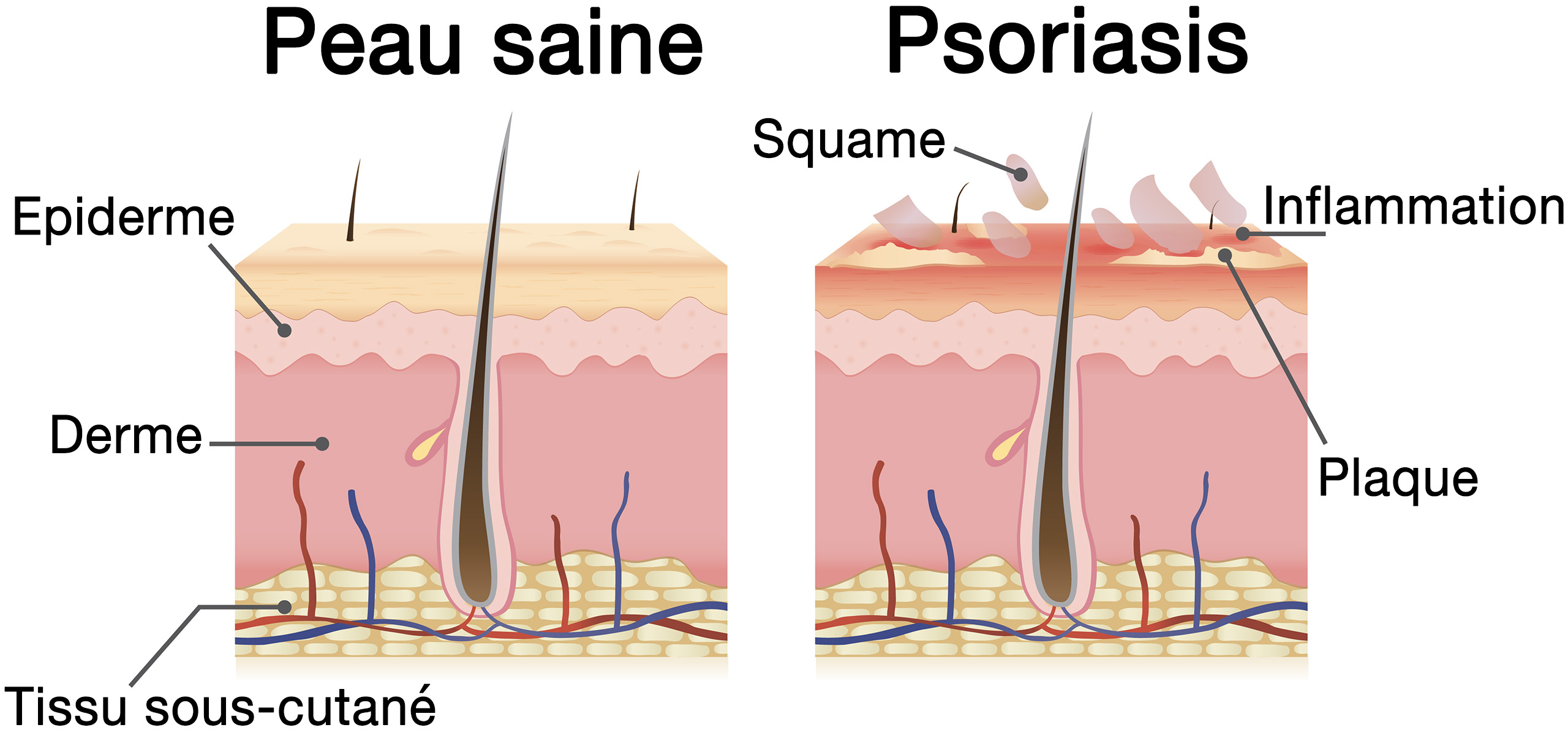 comparaison entre le psoriasis et une peau saine