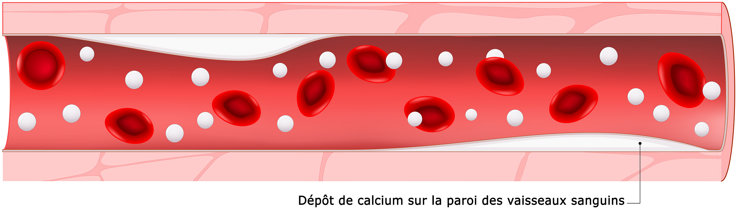 Schéma d'un dépôt de calcium dans un vaisseau sanguin 