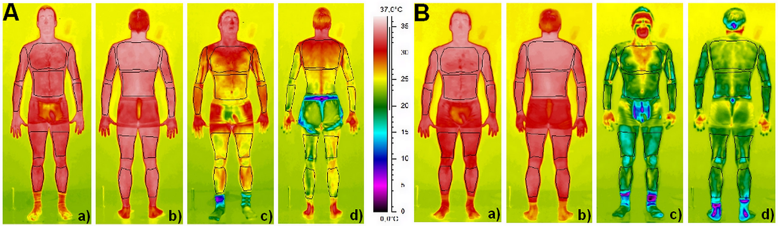Différence de thermogrammes avant (a,b) et après (c,d) une cryothérapie corps partiel (A) ou entier (B)